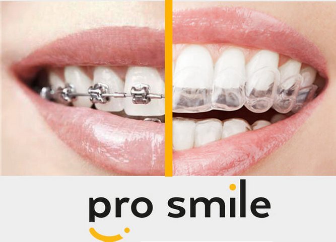 ProSmile — nakładki ortodontyczne